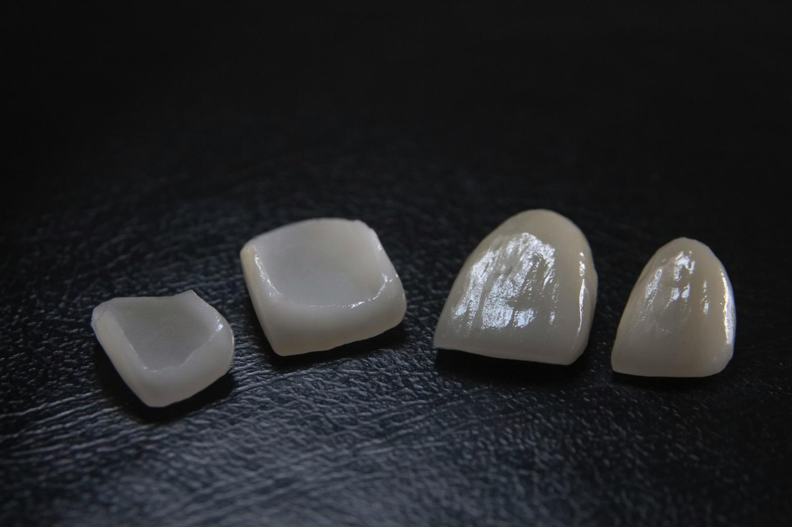 Indirect Porcelain Veneers