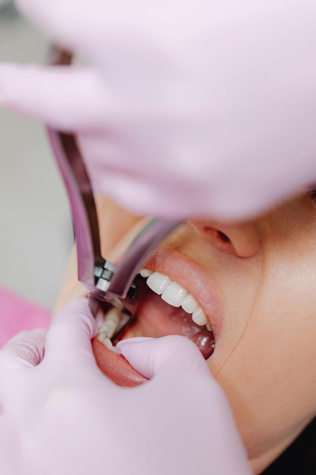 Tooth Extraction - Birstall