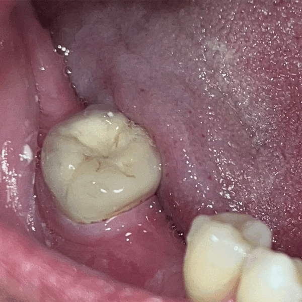 Crown Case - After