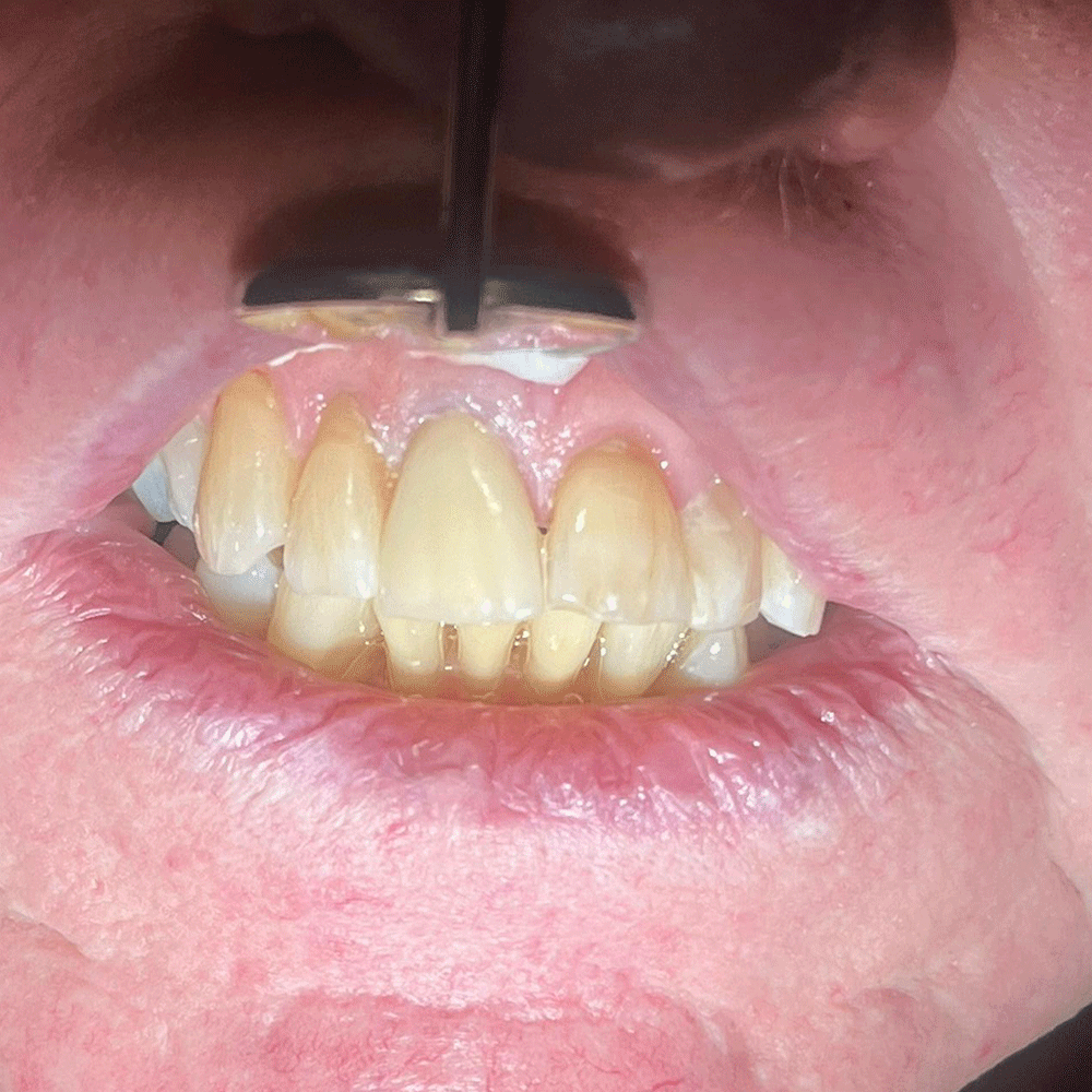 Crown- Restorative-Dentistry-After