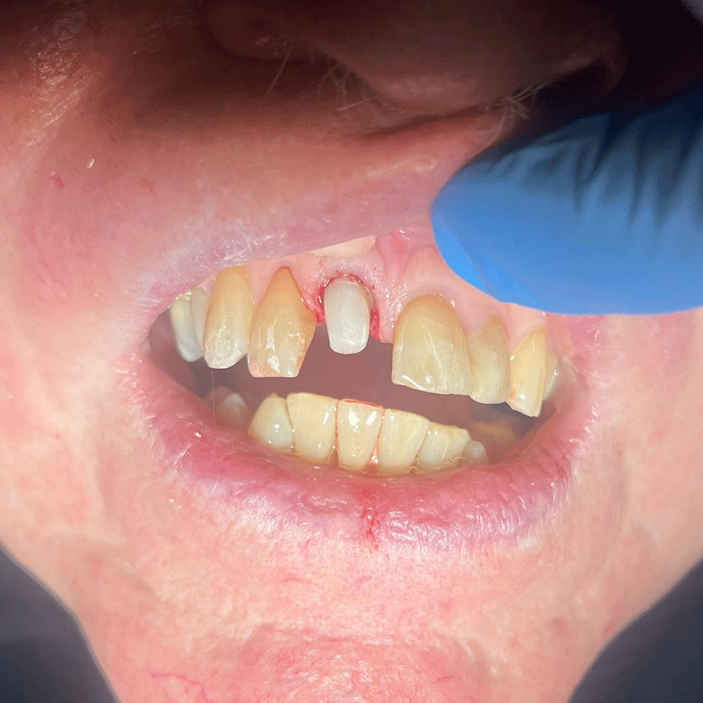 Crown Restorative Dentistry - Before