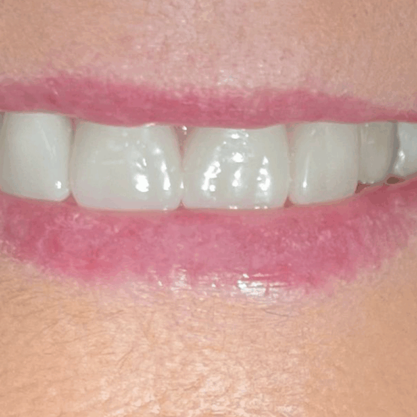 Denture in Birstall