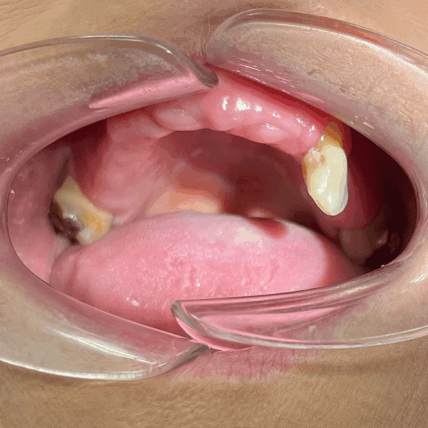 Denture in Birstall
