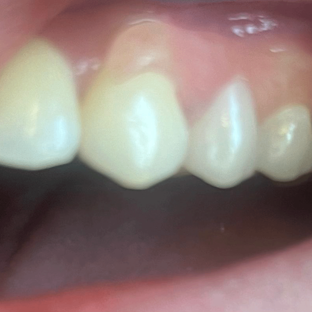 Flexi Valplast Single Denture
