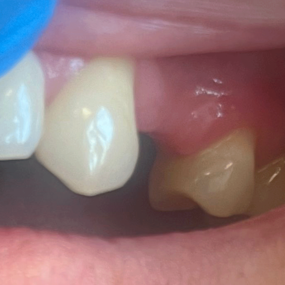 Flexi Valplast Single Denture - Before