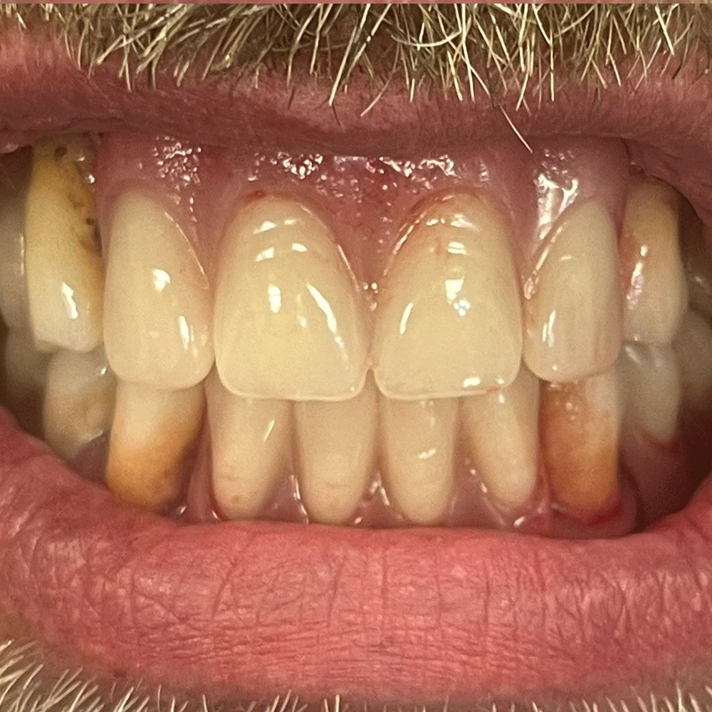 Dentures in Birstall