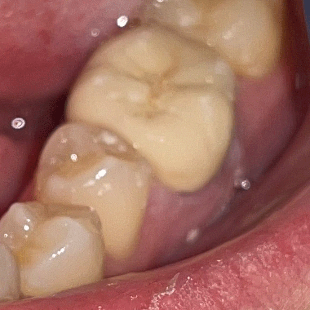 Lower Crown - After
