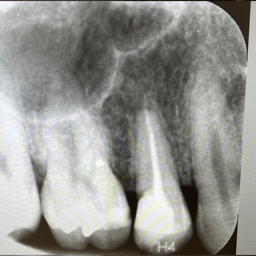 Root Canal in Birstall
