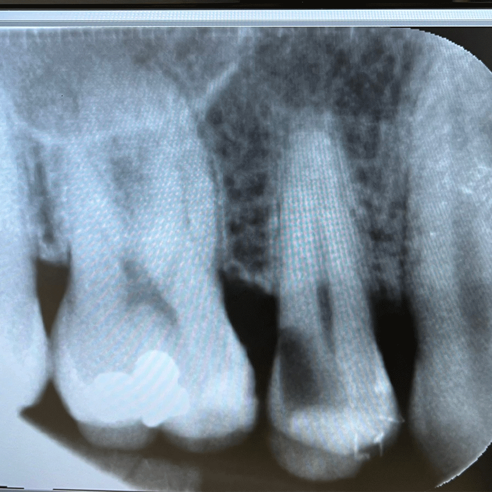Root Canal in Birstall