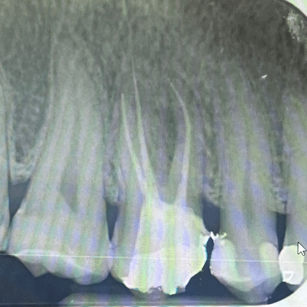Root Canal in Birstall