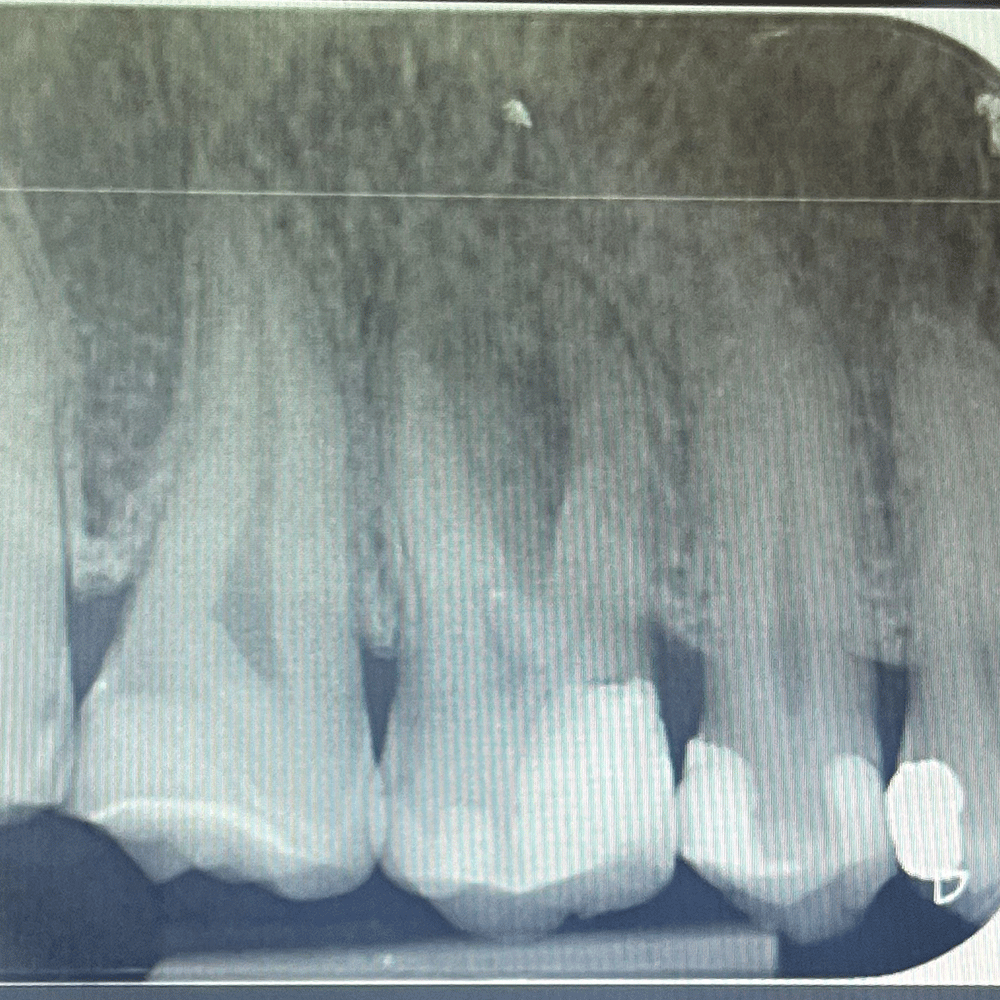 Root Canal in Birstall