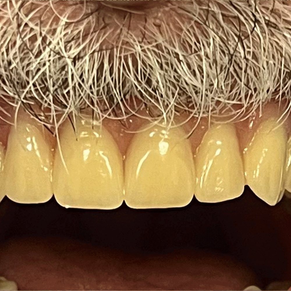 Dentures in Birstall