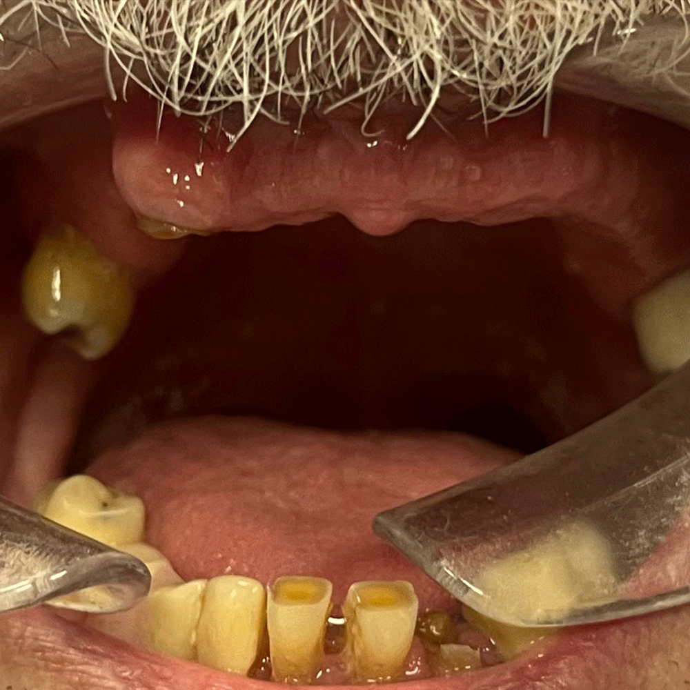 Dentures in Birstall