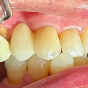 2-Unit Zirconia Bridge - After