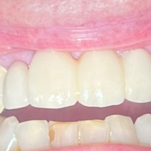 4-Unit Zirconia Bridge - After