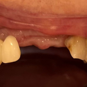 4-Unit Zirconia Bridge - Before