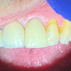Zirconia Crown - After