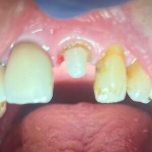 Zirconia Crown - Before